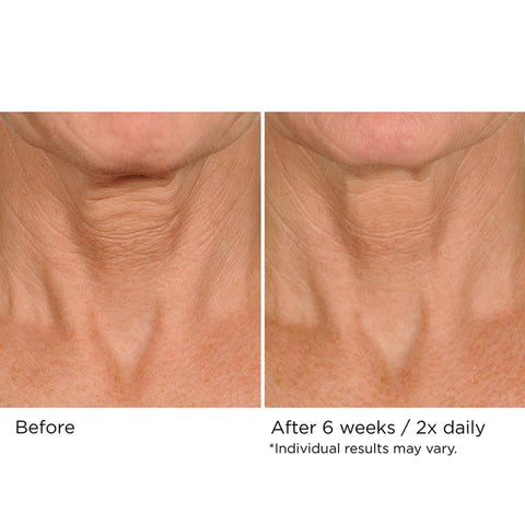 Neck Firming & Lifting Complex