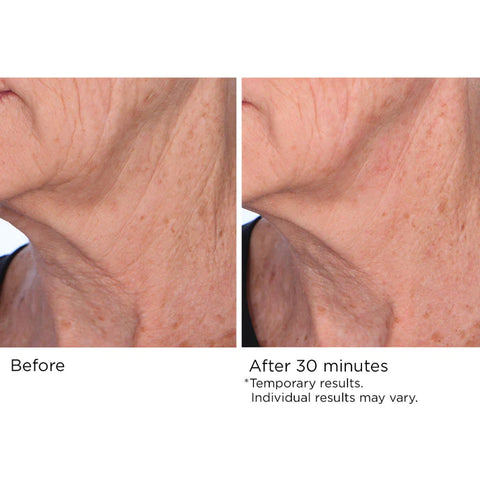 Quick fix Face and Neck Lift
